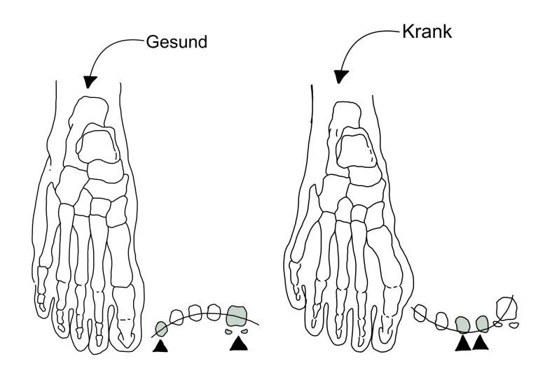 Spreizfuß
