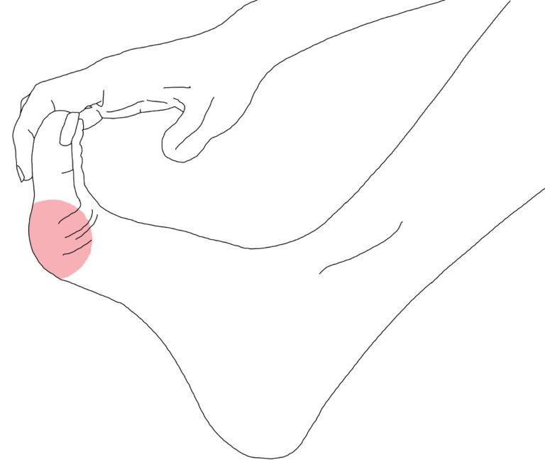 Hallux valgus